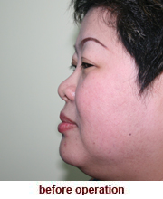 plastic_surgery_augmentation_rhinoplasty